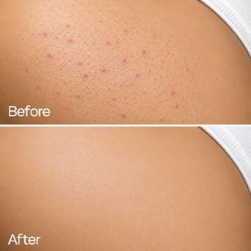 Ingrown Hair Serum For Razor Bumps & Smooth Skin - Image 7