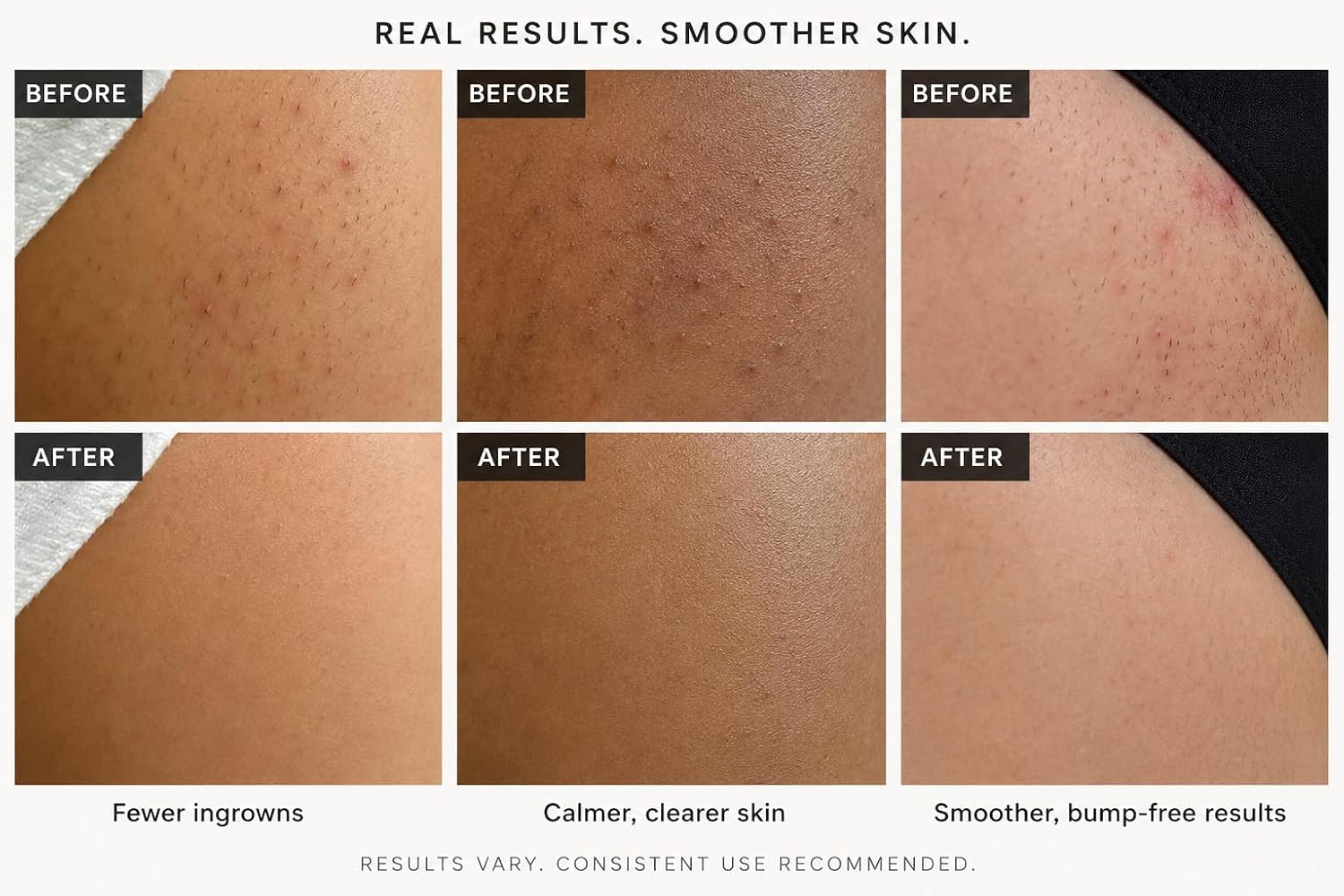 Ingrown Hair Serum For Razor Bumps & Smooth Skin - Image 4